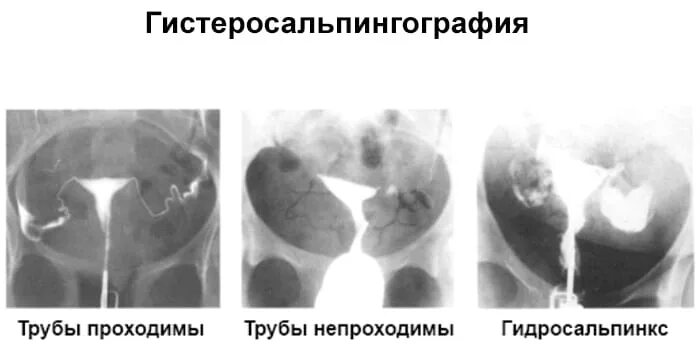 Не проходимость труб гинекология как определить фото Как делают проходимость труб у женщин