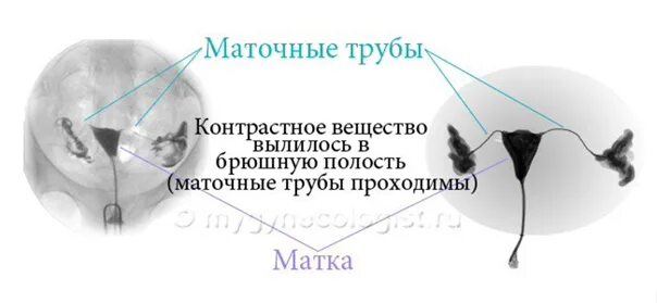 Не проходимость труб гинекология как определить фото ❗ Процедура ГИСТЕРОСАЛЬПИНГОГРАФИЯ (рентген маточных труб в Медицинском центре "
