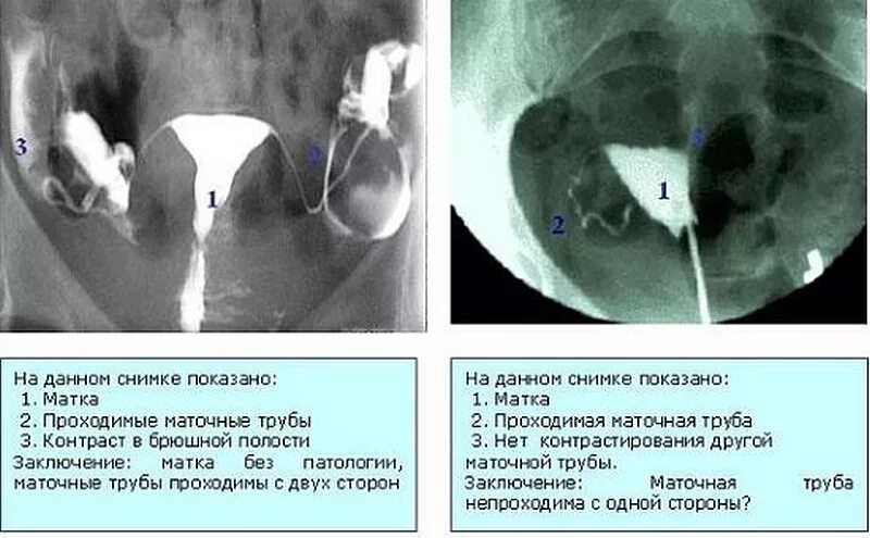 Не проходимость труб гинекология как определить фото Как проверяют проходимость маточных труб у женщин: найдено 77 картинок