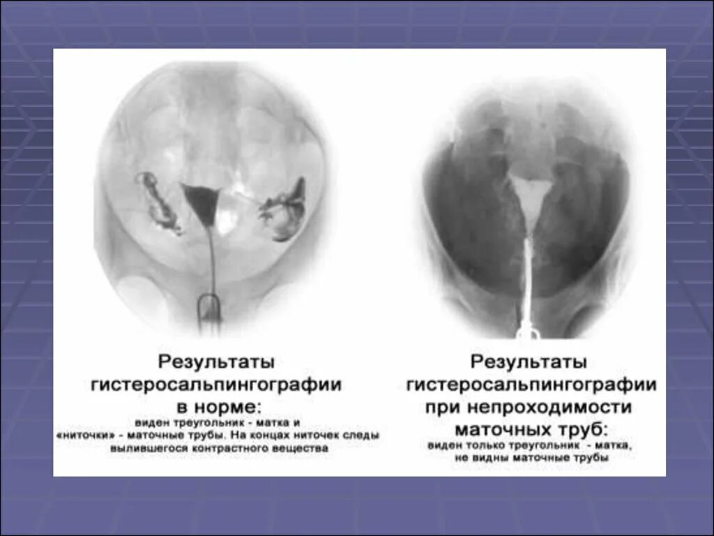 Не проходимость труб гинекология как определить фото Методика гистеросальпингографии рисунок