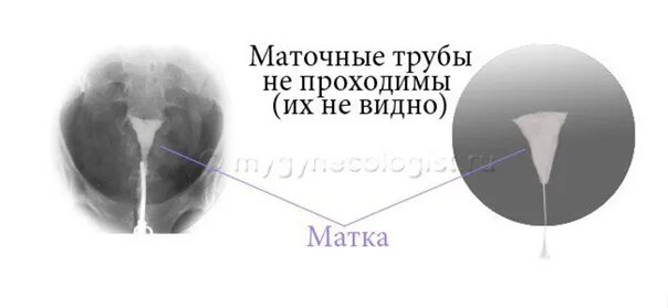 Не проходимость труб гинекология как определить фото ❗ Procedure of GISTERSALPINGOGRAPHIS (uterine tube x-ray) at VITA Medical Center