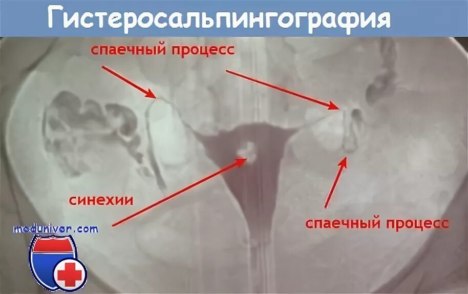 Не проходимость труб гинекология как определить фото Непроходимость маточных труб - как лечить? Почему не получается забеременеть?