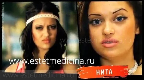Нита кузьмина до пластики фото Нита Кузьмина: до и после пластики. Много фото