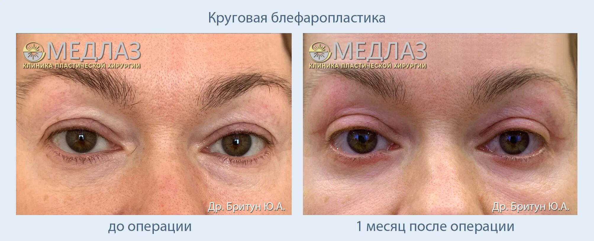 Нитевая блефаропластика век фото Круговая блефаропластика. Работы доктора Бритун Ю.А. - МедЛаз