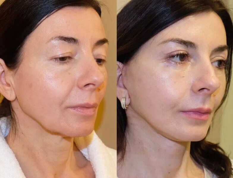 Нитевая коррекция лица фото до и после Миолифтинг
