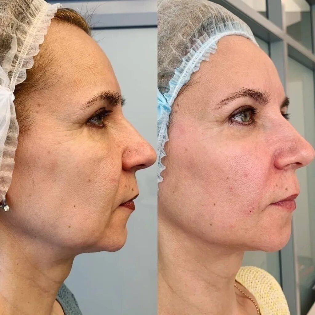 Нитевое армирование лица до и после фото Aesthedclinic - Поэтапная коррекция возрастных изменений кожи