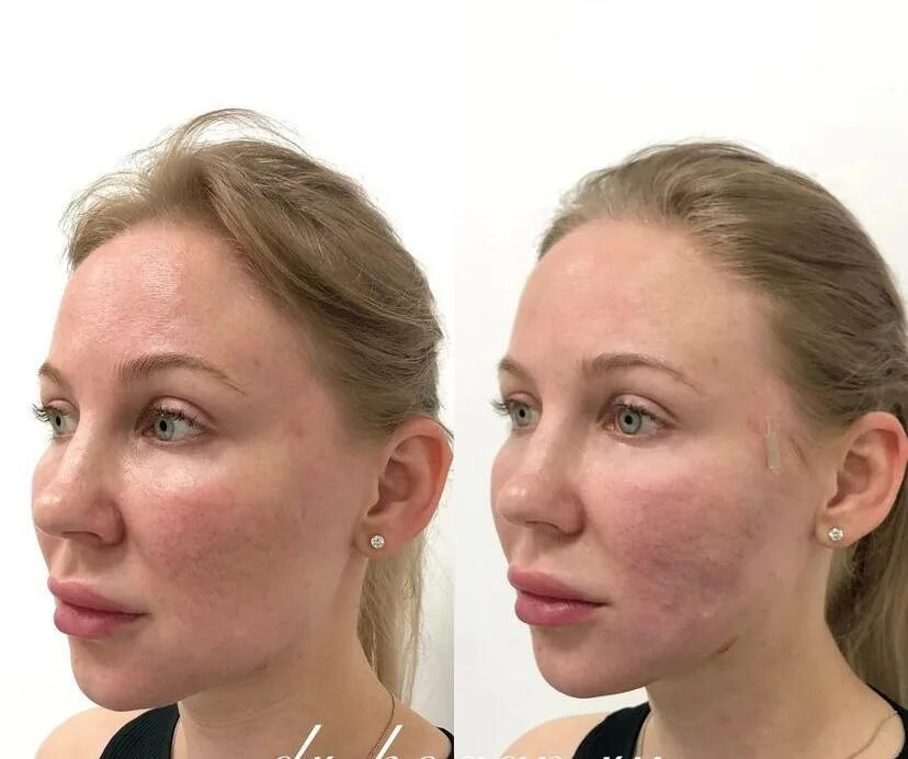 Нитевой лифтинг фото до и после Как выглядит подтяжка нитями в фото До и После - Cosmetic-clinic