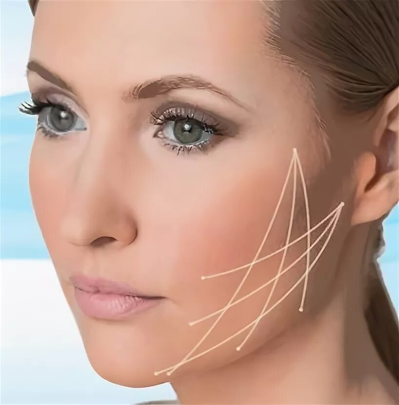 Нитевой лифтинг лица фото Нити APTOS - Клиника здоровья и красоты Novo Clinik