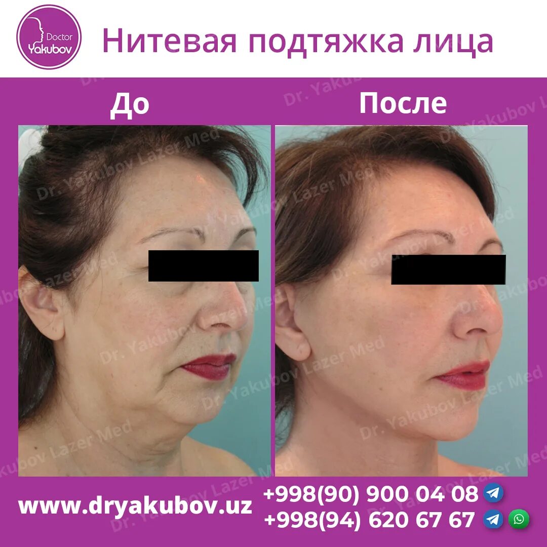 Нитевой лифтинг лица отзывы фото Картинки НИТИ КОГА ФОТО ДО И ПОСЛЕ ОТЗЫВЫ