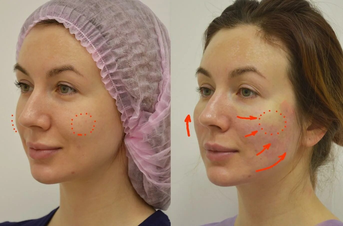 Нитевой лифтинг лица отзывы фото Процедура инъекционной подтяжки лица filler.by