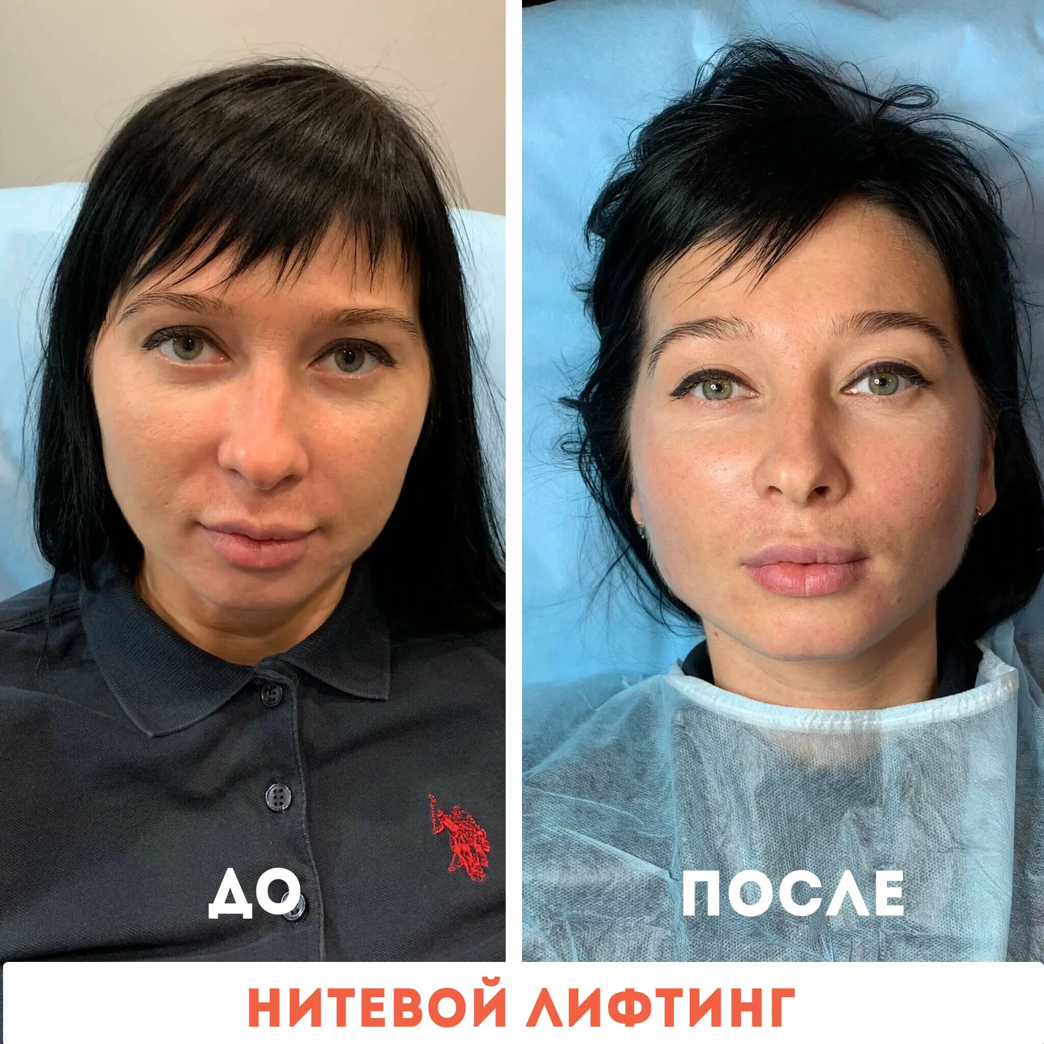 Нитевой лифтинг лица отзывы фото Нитевой лифтинг в Москве, цены в студии косметологии Философия Стиля