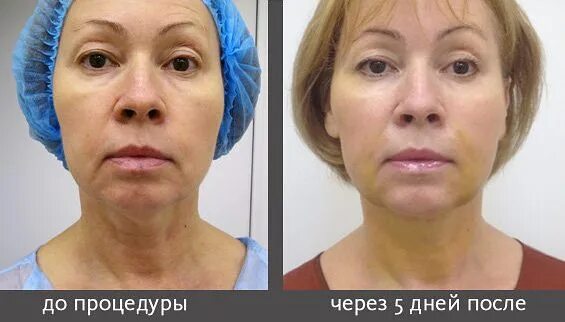 Нити аптос фото до и после Фотографии на стене сообщества - Фотография 8 из 25 ВКонтакте