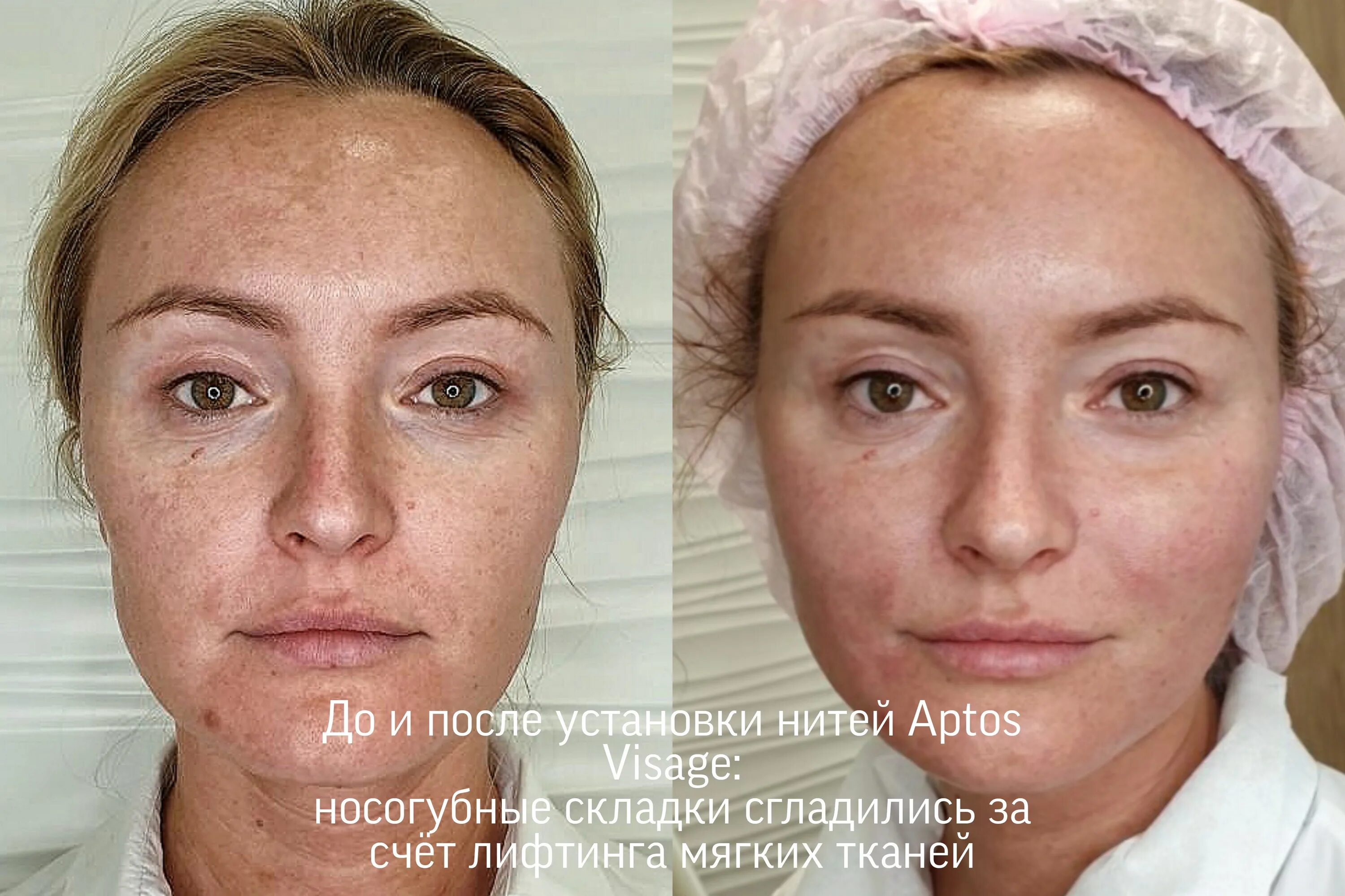 Нити аптос фото до и после Нити Аптос, нитевой лифтинг лица и тела нитями Aptos в Ижевске
