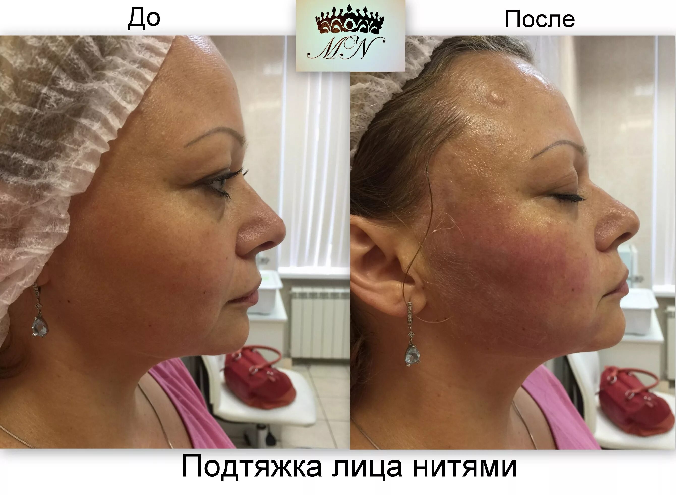 Нити для лица фото после процедуры Подтяжка лица нитями, подтяжка груди, нити для подтяжки