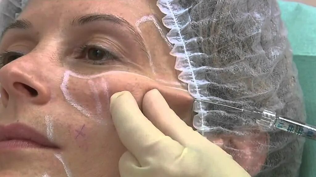 Нити для лица в косметологии фото CLIP SOFTFIL CLASSIC & PRECISION - YouTube