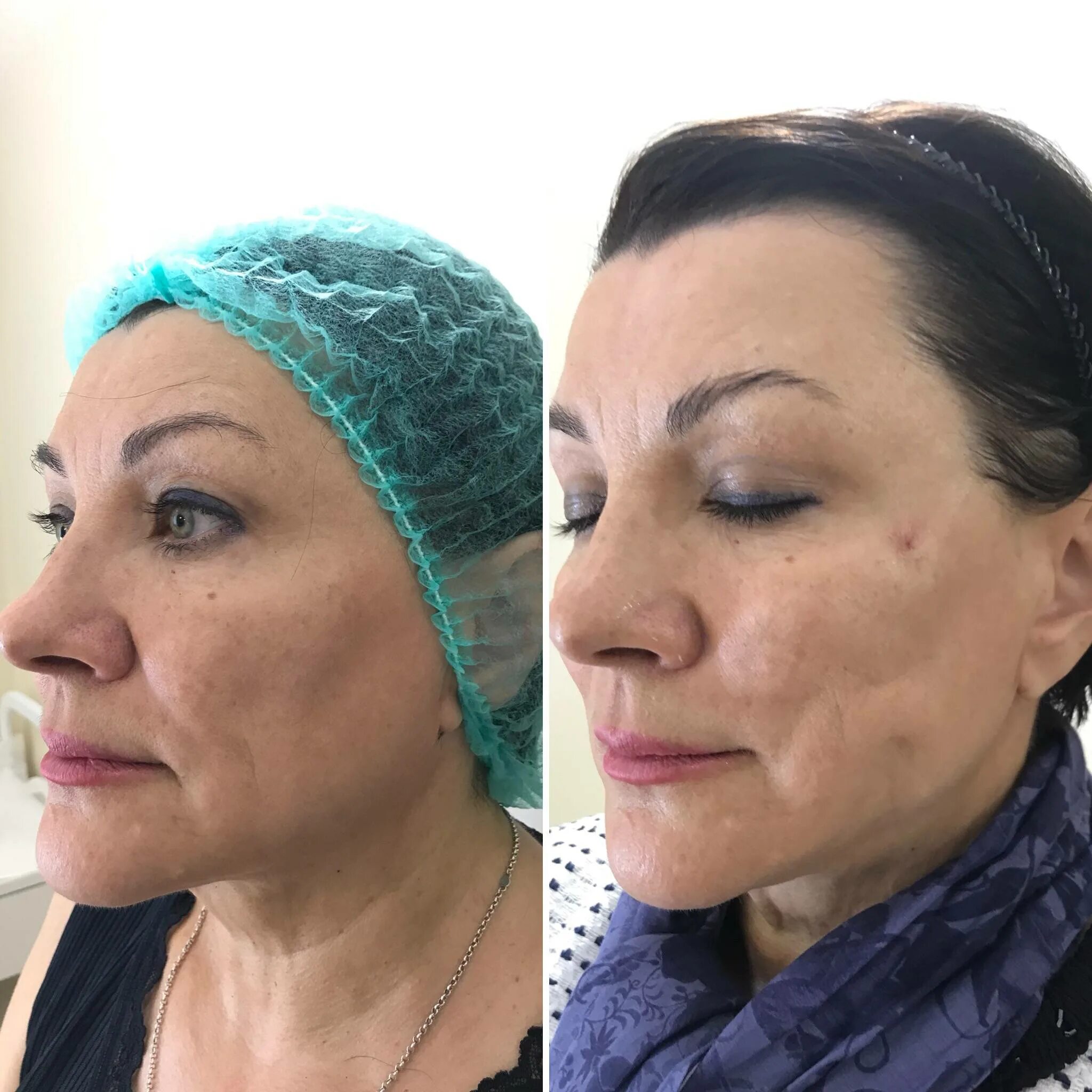 Нити для подтяжки лица отзывы фото Нити аптос (aptos): результаты омоложения и осложнения