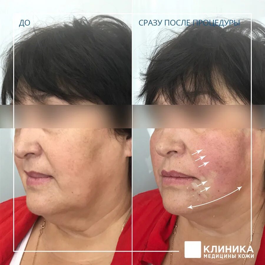 Нити для подтяжки лица отзывы фото Нити Аптос для подтяжки лица: цена нитевого лифтинга Aptos в СПб