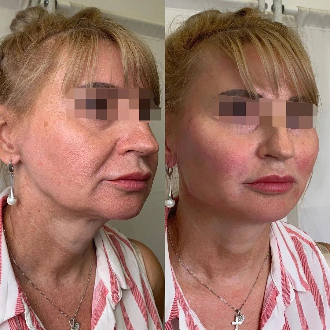 Нити для подтяжки лица отзывы фото Реабилитация после подтяжки нитями: найдено 87 изображений