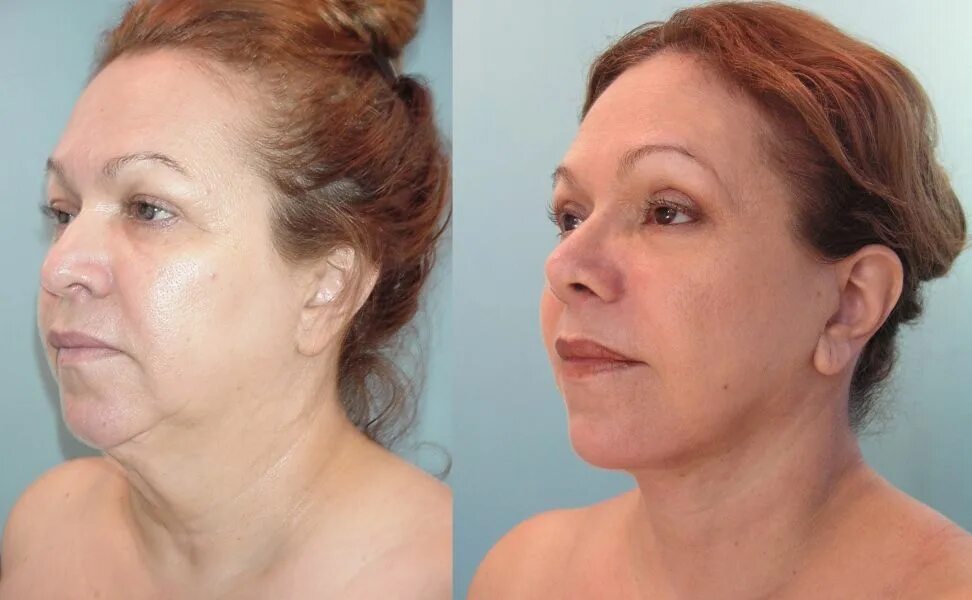 Нити для подтяжки лица после 50 фото LIFTING ENDOSCÓPICO (sin cortes): Se realiza sin la cicatriz convencional detrás