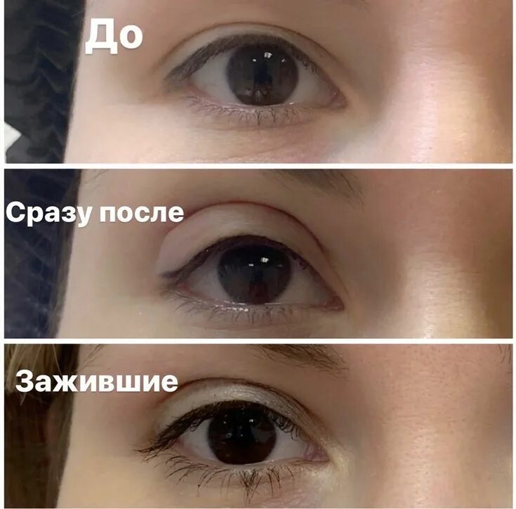 Нити для век фото Нитевой лифтинг век сингапури открыть глаз нависшее веко мезонити подтяжка расса