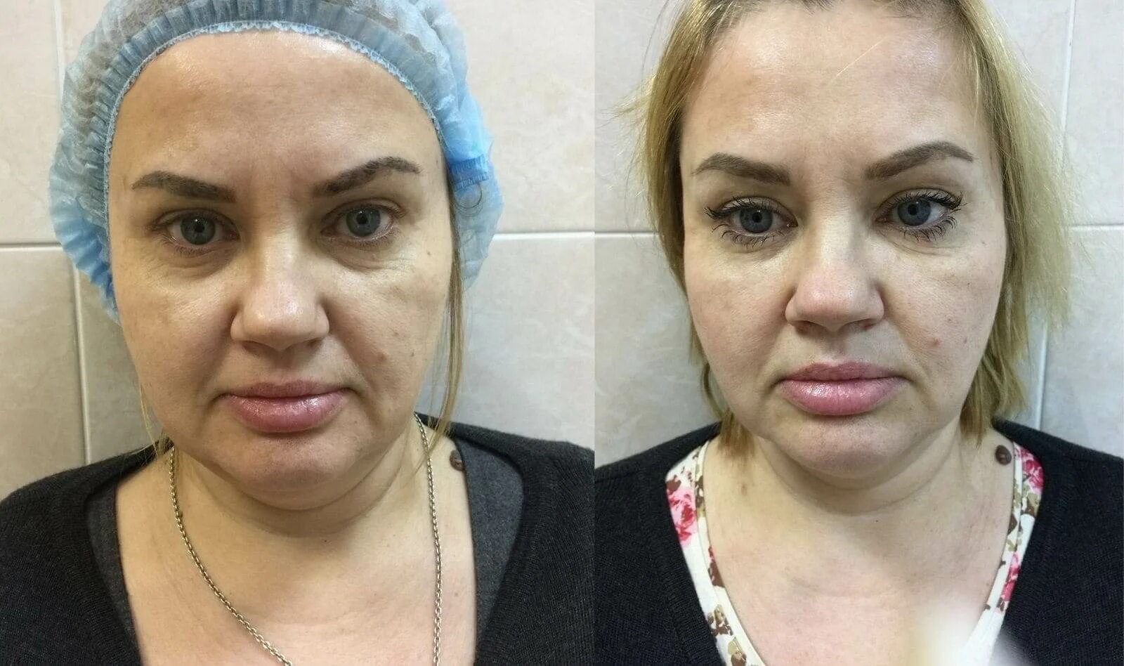 Нити до и после фото Плазмолифтинг в Санкт Петербурге. Цены на лазерный плазмолифтинг - AesteticaMed