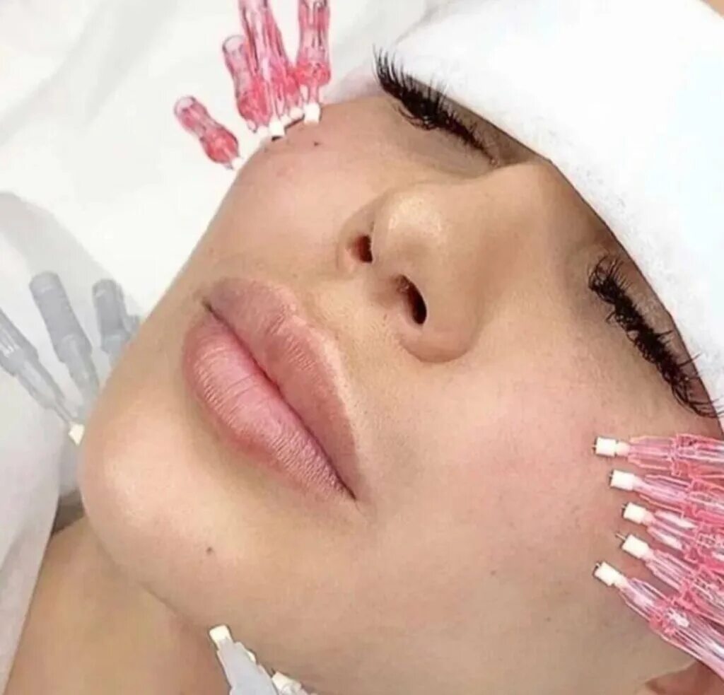 Нити коги для подтяжки лица фото Natali, cosmetology, Lyubertsy, Gorodok B Microdistrict, 3rd Pochtovoye Otdeleni