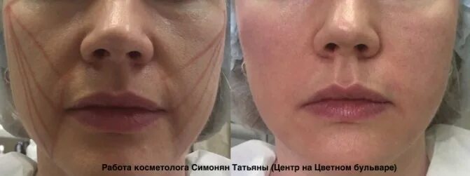 Нити коги для подтяжки лица фото Подтяжка лица 4D нити, нити в канюлях Новосибирск, Косметология
