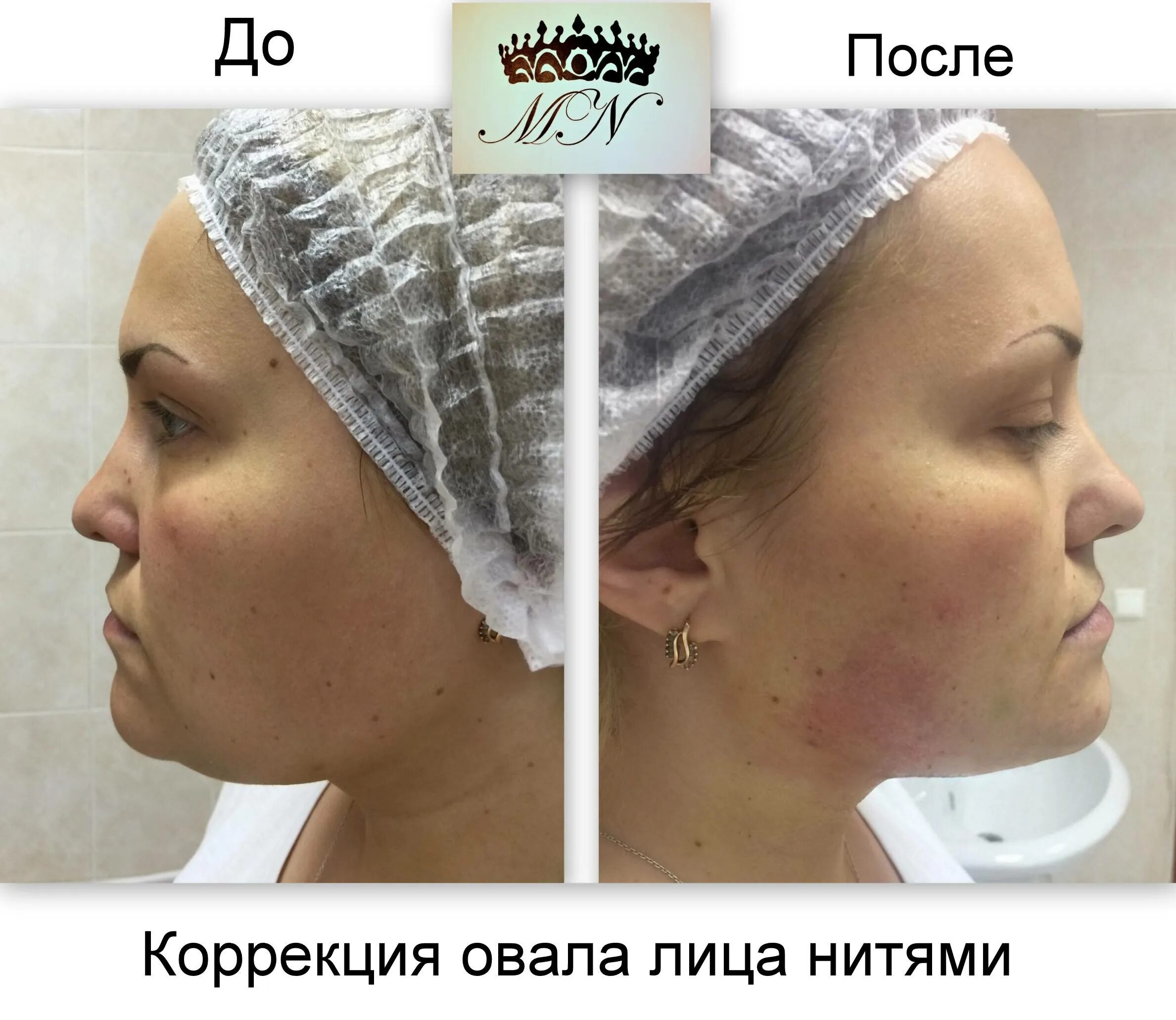 Нити коги до и после фото отзывы Армирование нитями лица отзывы: найдено 86 изображений