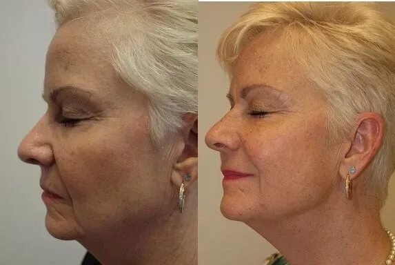 Нити коги фото до и после Facial Beauty Korea Hilos Tensores Pdo 3d 4d Cog Barbed Face Lifting Thread - Bu