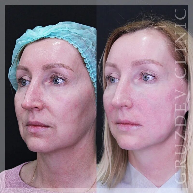 Нити косметология фото до и после The result after the procedure of thread lifting of the middle third of the pers