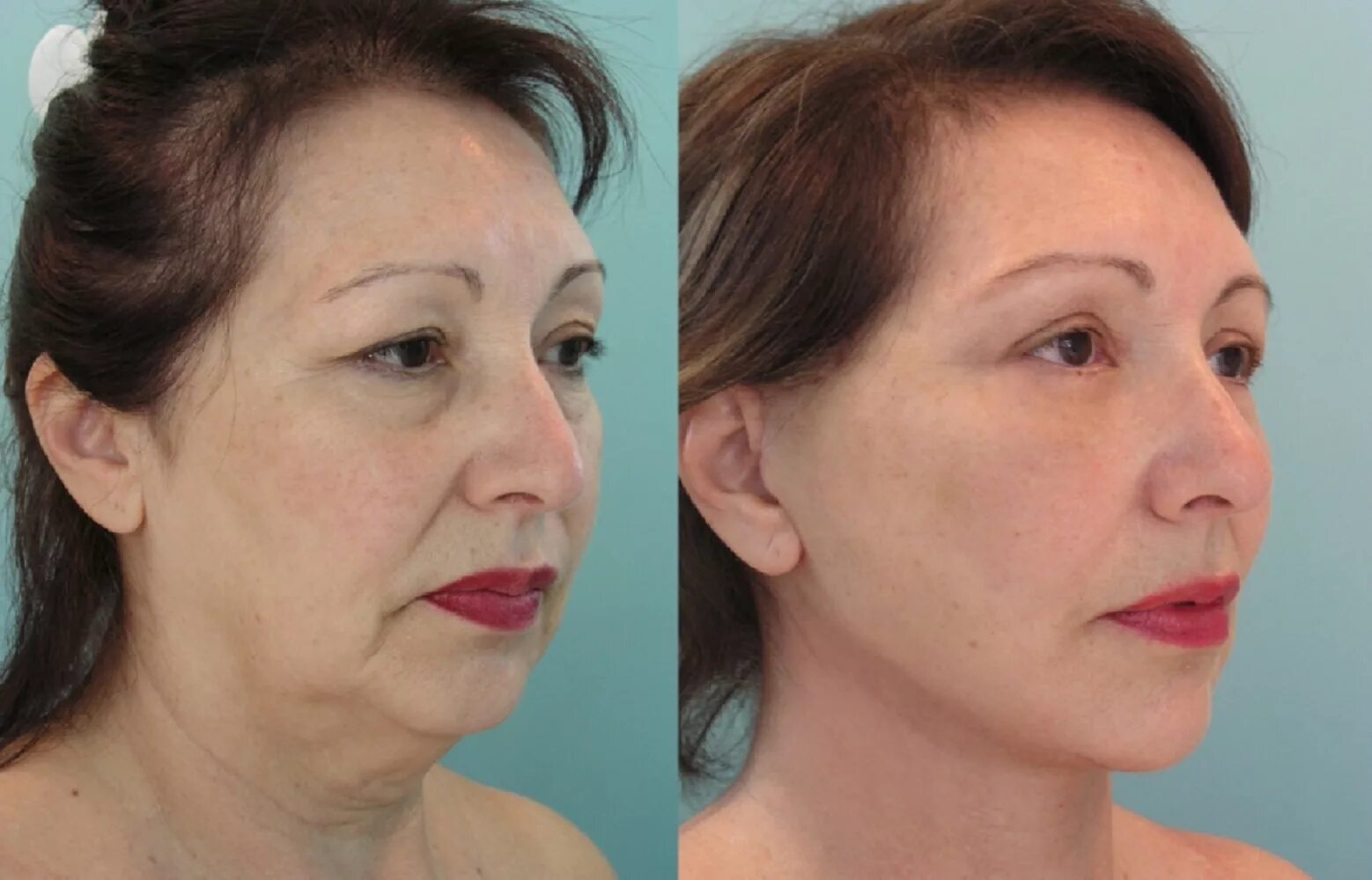 Нити косметология фото до и после Нитевой лифтинг. Подтяжка лица нитями filler.by