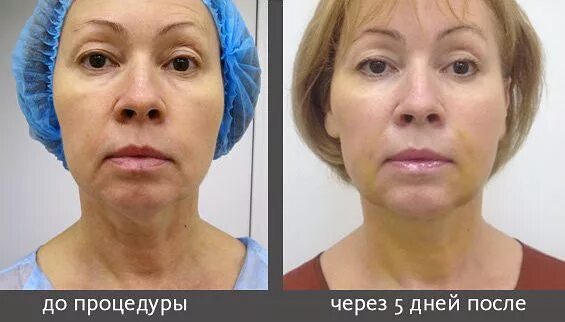 Нити лицо отзывы фото Нитевой лифтинг лица после 50 лет * Отзывы с фото до и после подтяжки, какие нит