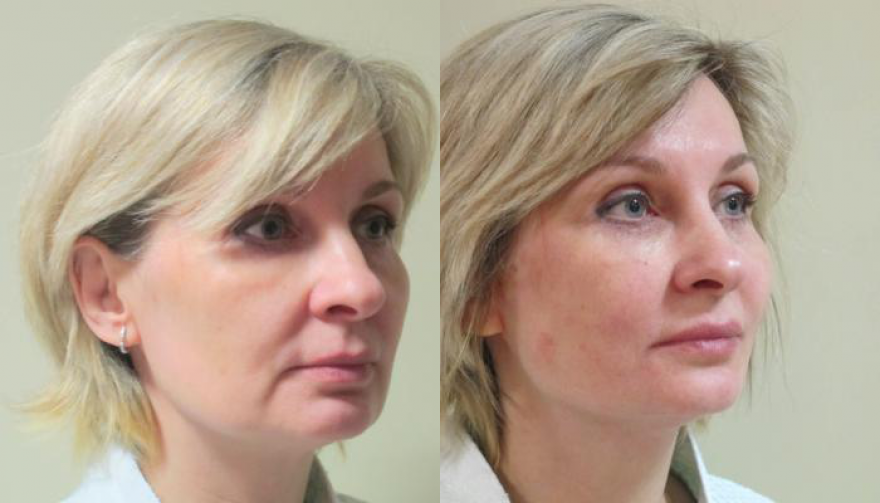 Нити лицо отзывы фото Как подтягивают лицо нитями? Всё о нитевом лифтинге Красота и уход Дзен