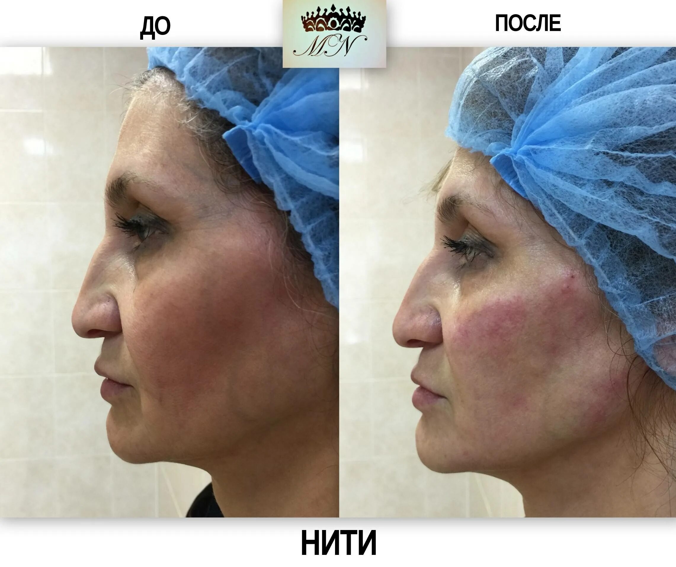 Нити лицо отзывы фото Нити коги отзывы фото