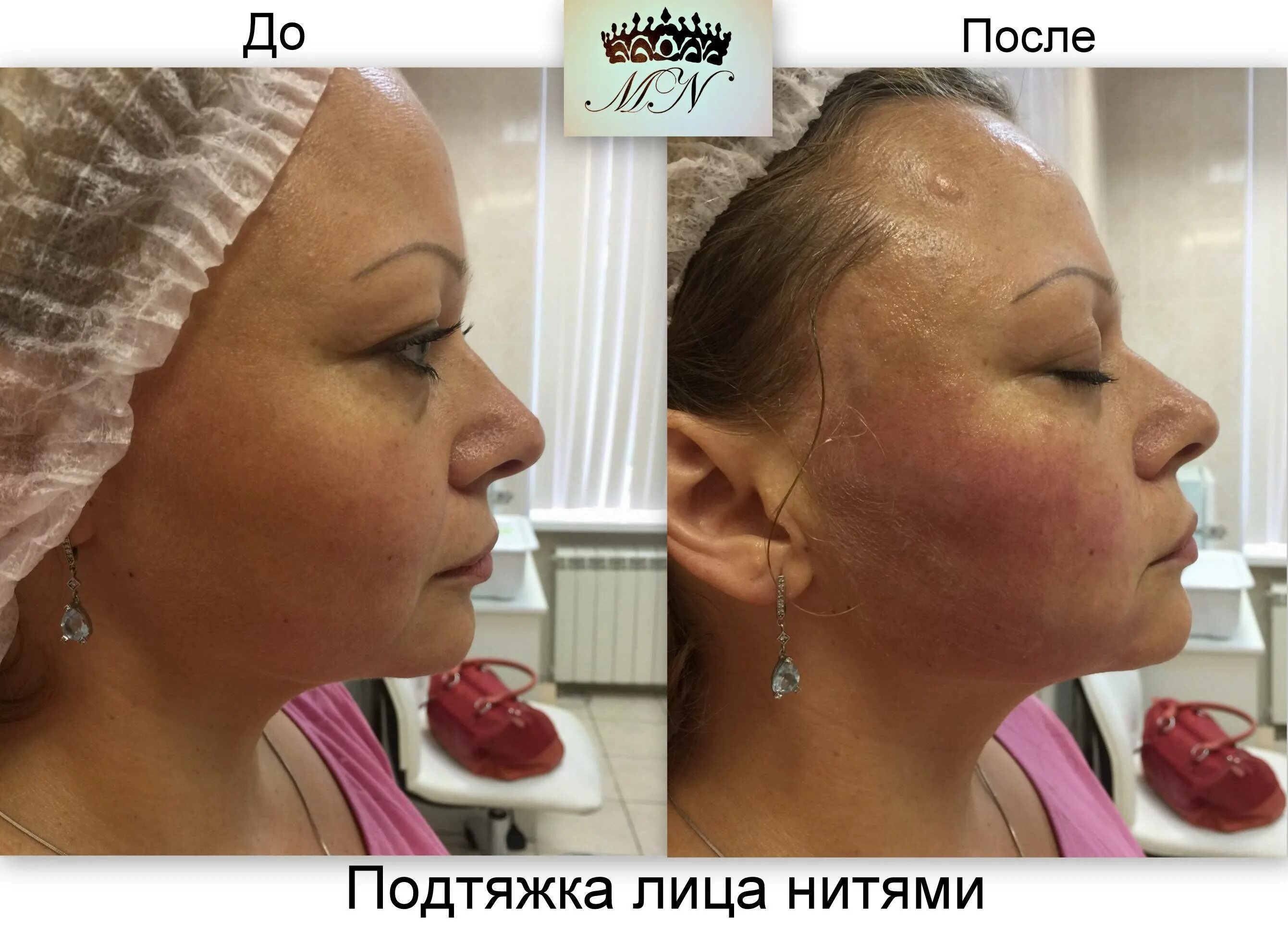 Нити лицо отзывы фото Нитевой лифтинг плюсы и минусы: найдено 84 изображений