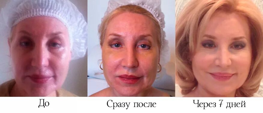 Нити на лицо до и после фото Нитевой лифтинг: новое слово в косметологии