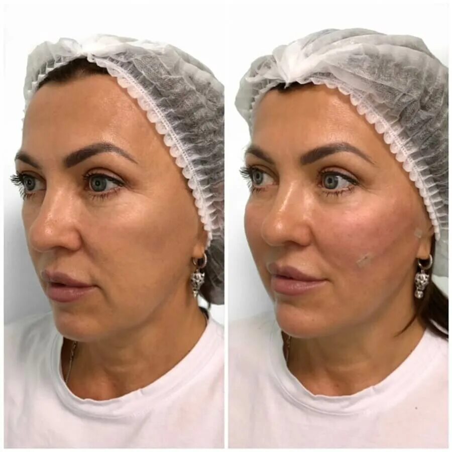 Нити на лицо до и после фото Косметология NEO CLINIC