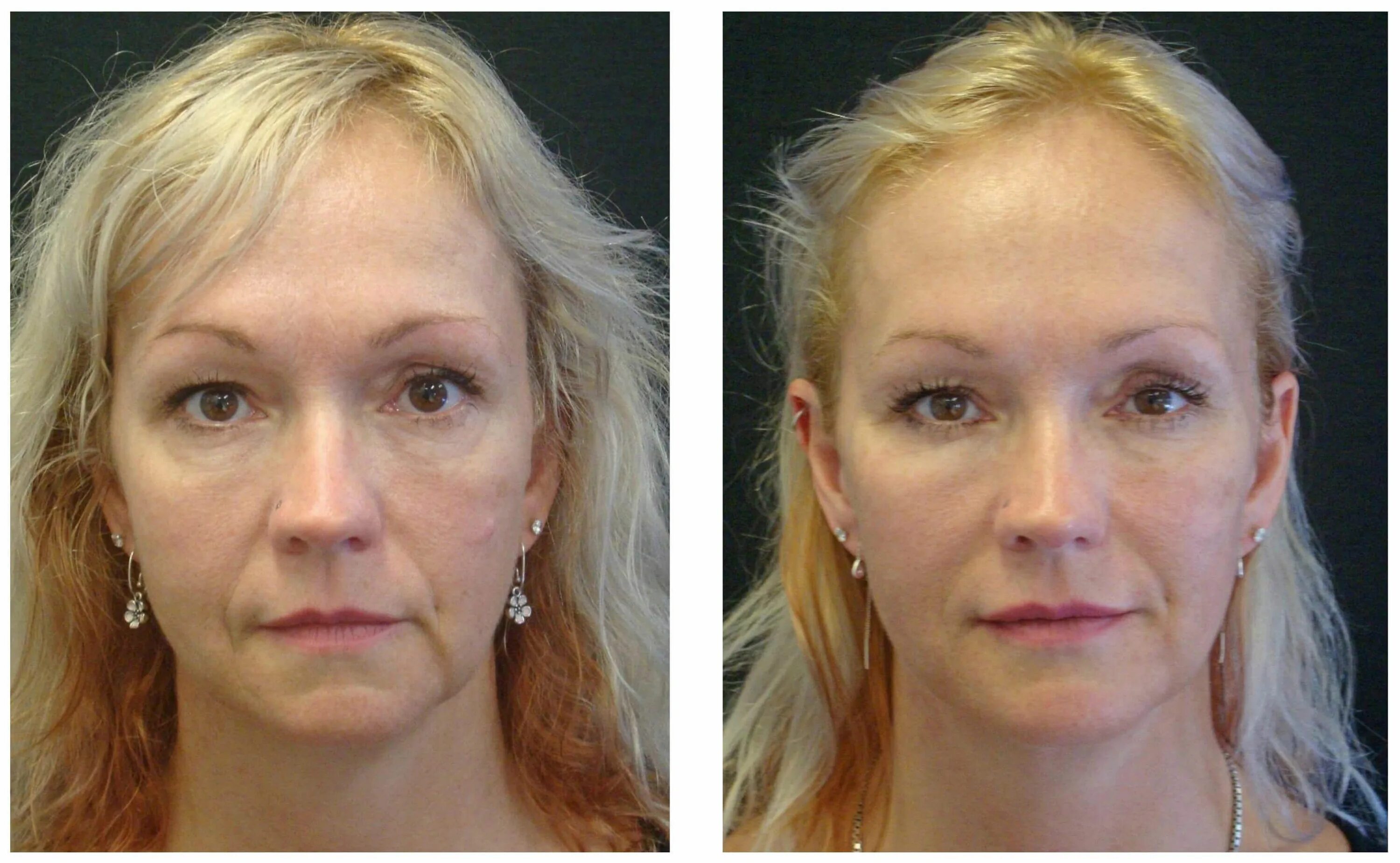 Нити пластика лица до и после фото The All New Option Of Wrinkle Filler In Boston Cheek wrinkles, Dermal fillers, B