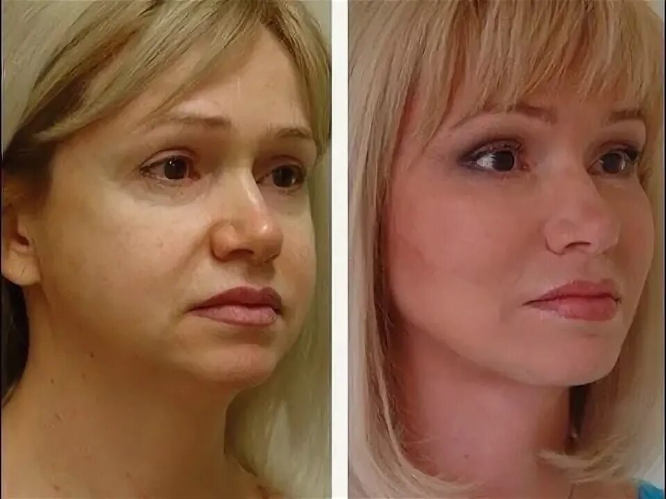Нити пластика лица до и после фото Hydroface Bestellen Jünger aussehen, Gesicht pflege, Gesicht
