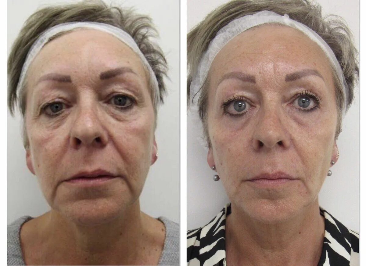 Нити под глаза до и после фото Thread Lift: Complications, Before and After, Recovery, and Cost Facial, Rostros