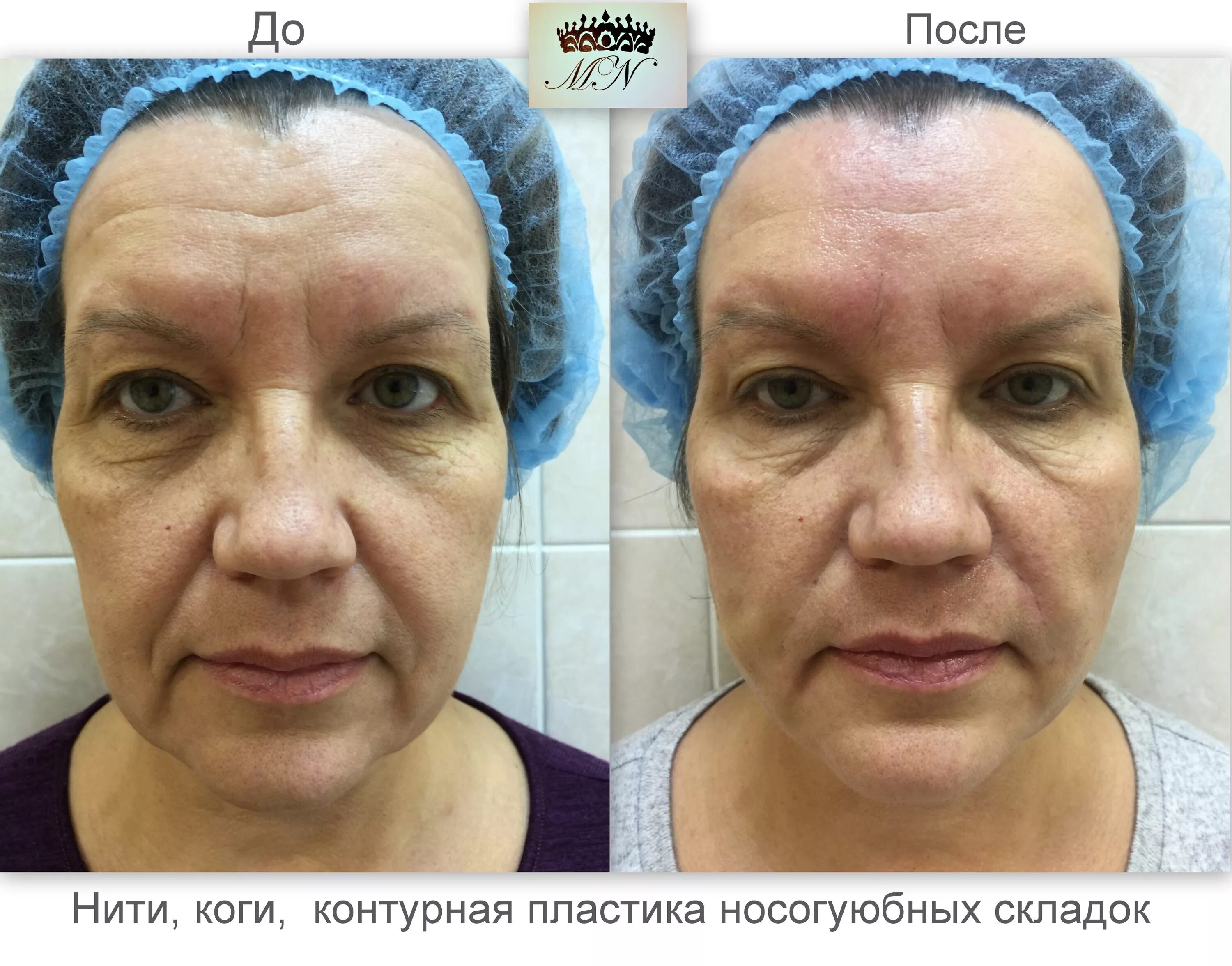 Нити под глаза до и после фото Мезонити - цена, фото до и после процедуры, отзывы пациентов. стоимость тредлифт