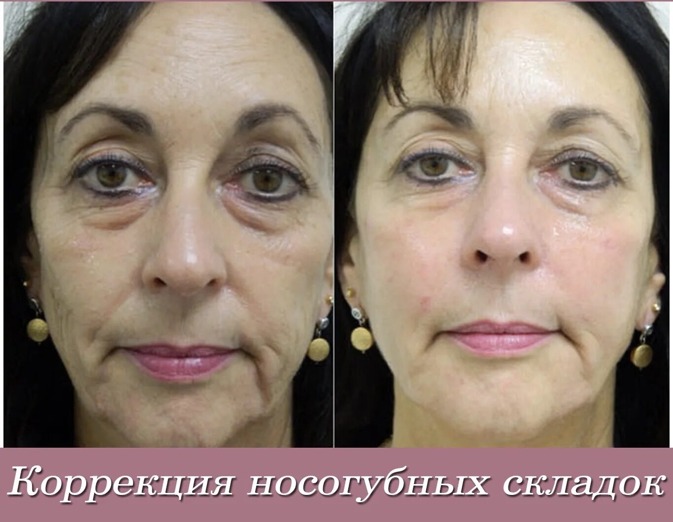 Нити под глаза отзывы фото Мезонити глаза фото до и после: найдено 89 изображений
