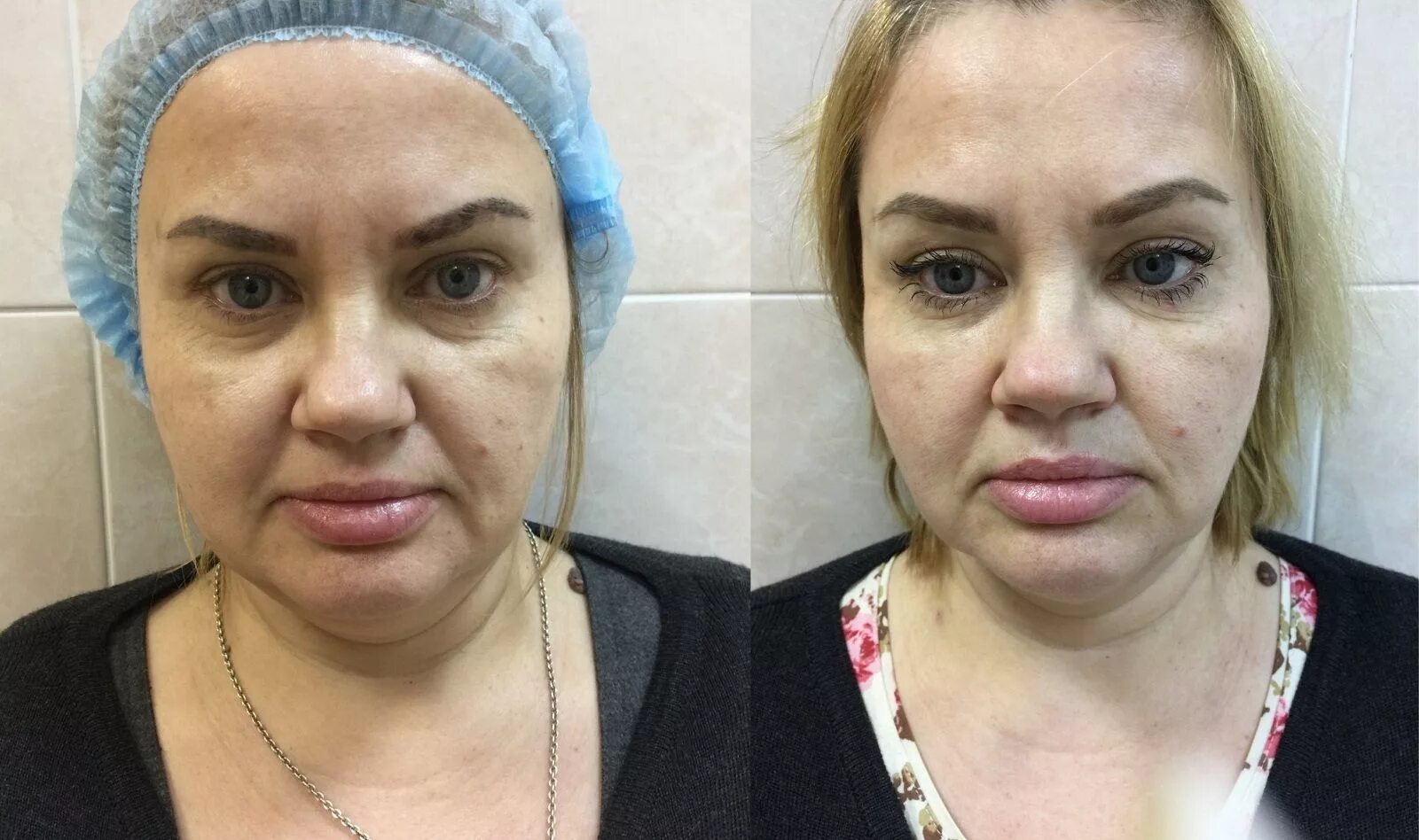 Нити под глаза отзывы фото Мезонити в СПБ - лучшие цены на подтяжку лица. Клиника NJMed