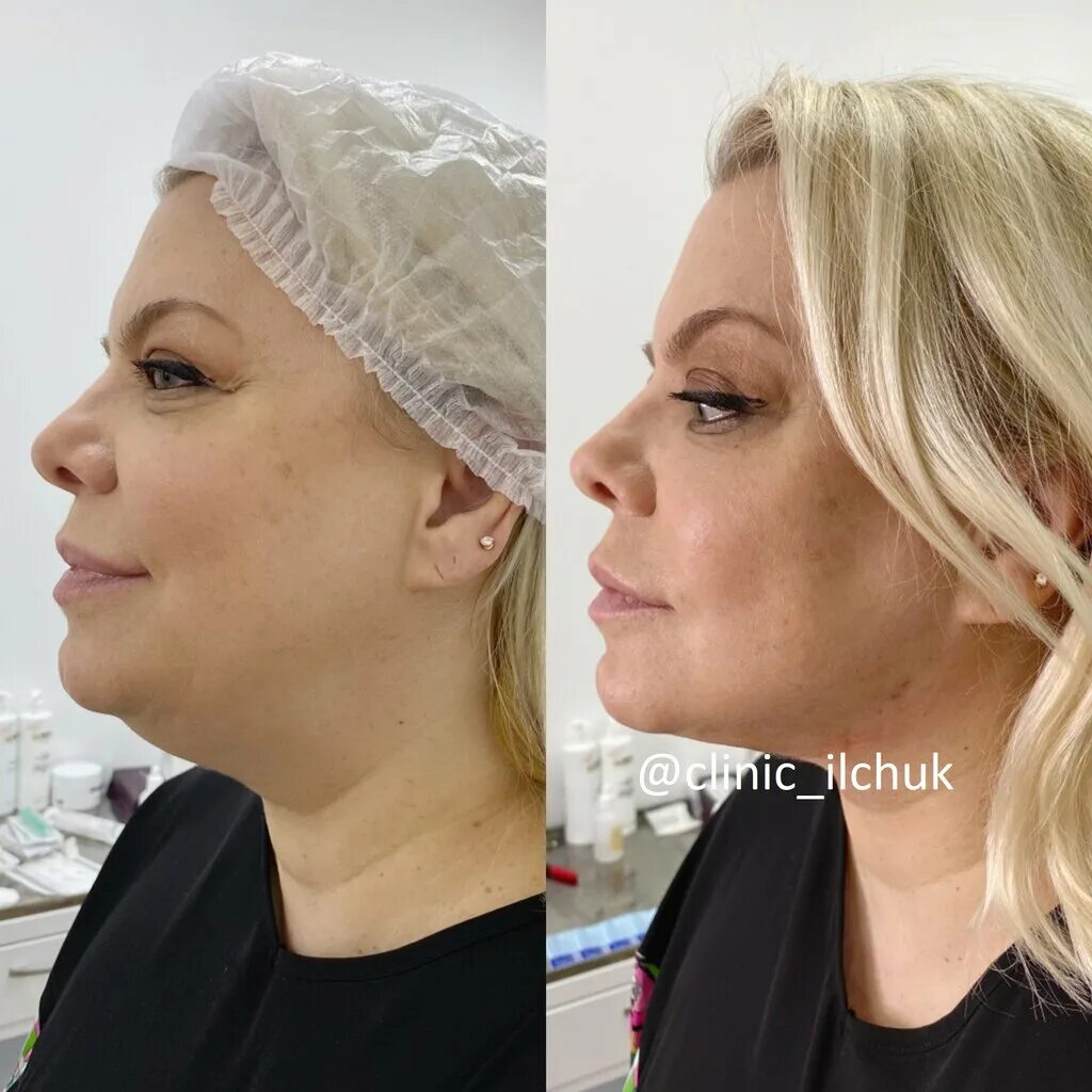 Нити в лицо фото Cosmetologiya Eleni Ilchuk, cosmetology, Россия, Москва, Даев переулок, 31, стр.