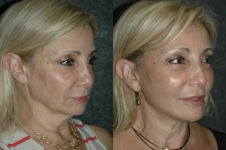 Нити в лицо фото Neck lift Neck lift, Neck surgery, Plastic surgery