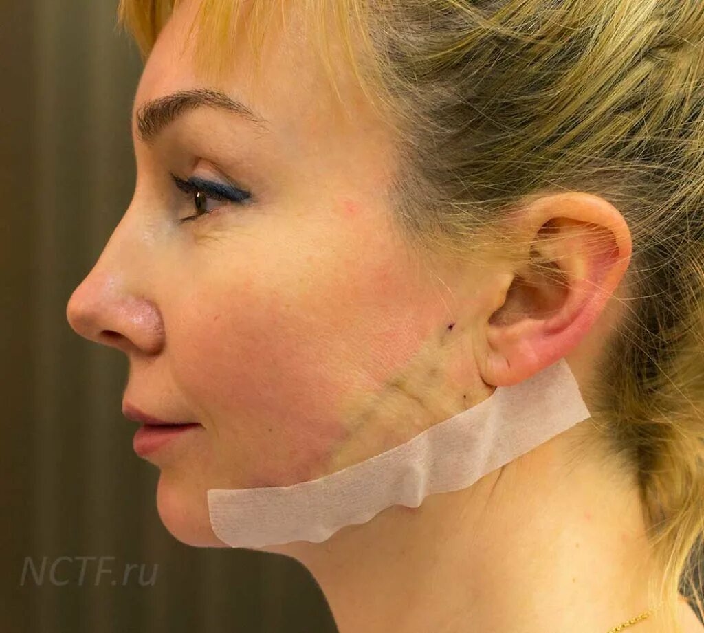 Нити в лицо фото Нити на лице для подтяжки