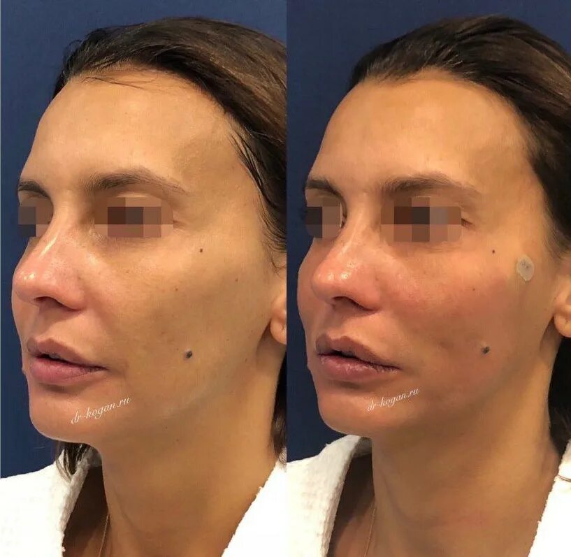Нити в лицо фото Будет ли больно во время и после подтяжки нитями? - Cosmetic-clinic
