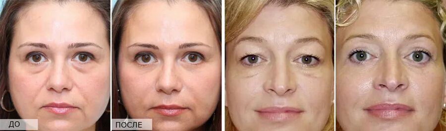 Нити веко фото до и после About mimic wrinkles around the eyes: how to get rid of at home, means