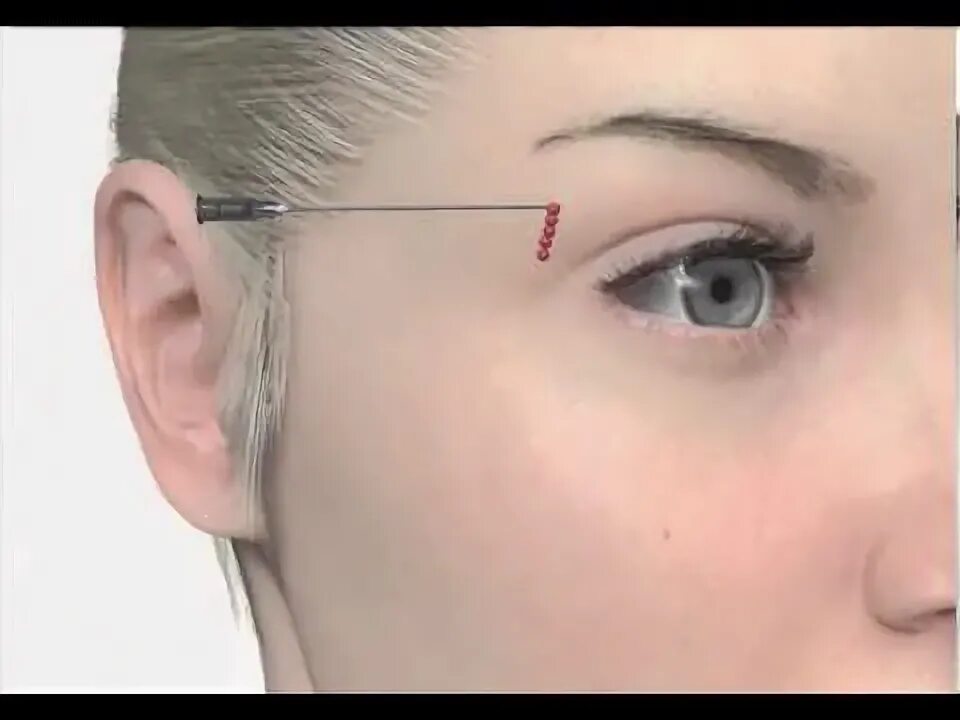 Нити веко фото до и после Dermatokosmetoloq Dr Jalə Həsənova - 3D - YouTube