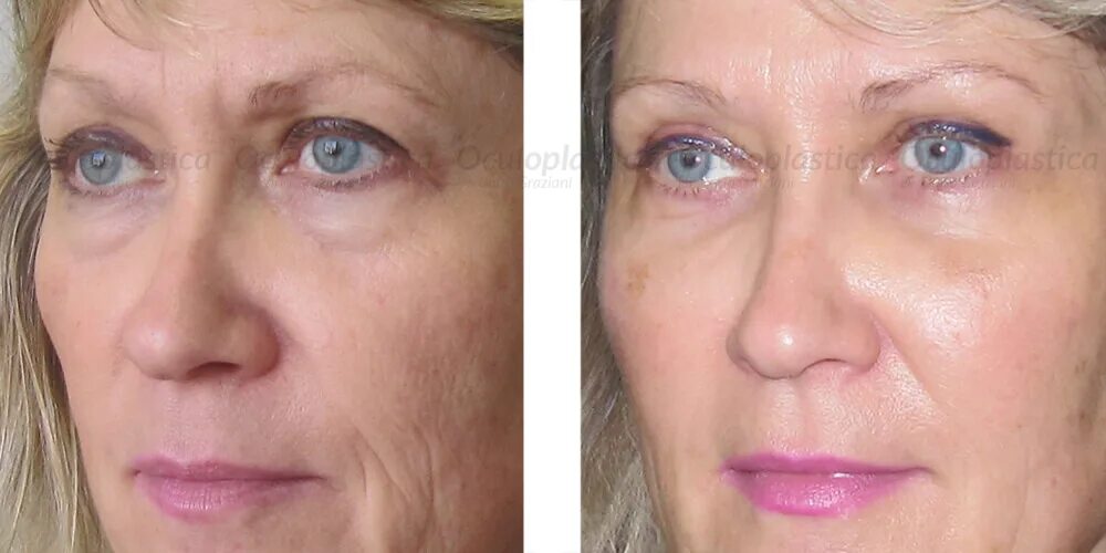 Нити веко фото до и после Eyebrow Lifting Beauty treatment Oculoplasty Dr Graziani